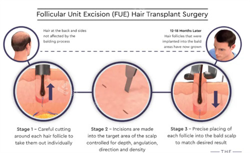FUE手术过程