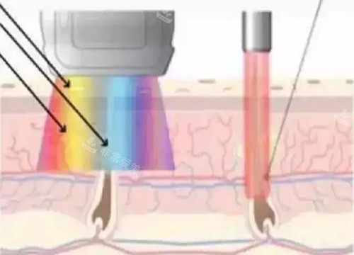 激光祛疤作用光波示意圖