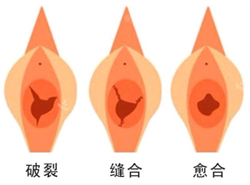 处女膜修复手术前后对比图
