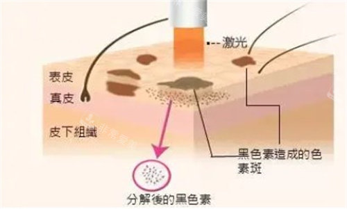 激光祛斑手術(shù)原理圖