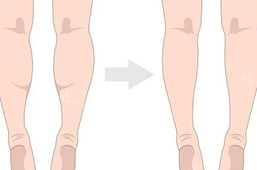 吸脂瘦小腿 吸脂瘦小腿