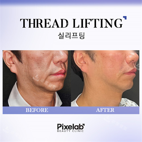 韓國Pixelab醫(yī)院面部抗衰手術前后對比 韓國Pixelab醫(yī)院面部抗衰手術前后對比