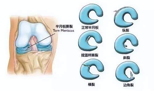 半月板損壞的類型