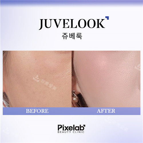 Pixelab醫(yī)院嫩膚+美白前后對(duì)比 Pixelab醫(yī)院嫩膚+美白前后對(duì)比