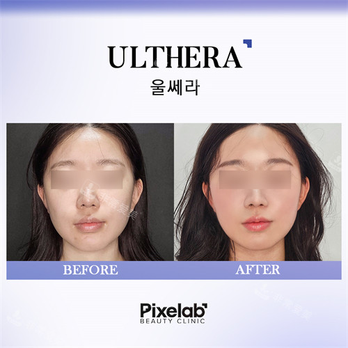 Pixelab醫(yī)院玻尿酸填充前后 Pixelab醫(yī)院玻尿酸填充前后