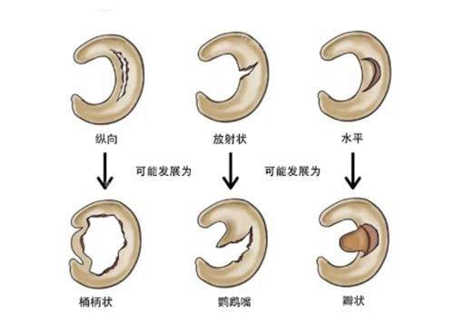 半月板损伤的后果