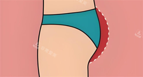 臀部提升區(qū)域 臀部提升區(qū)域