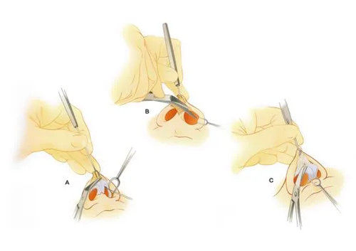 隆鼻整形切口示意圖