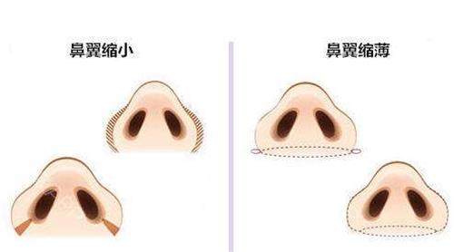 鼻翼縮小 鼻翼縮小