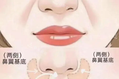 鼻翼、鼻基底卡通圖 鼻翼、鼻基底卡通圖