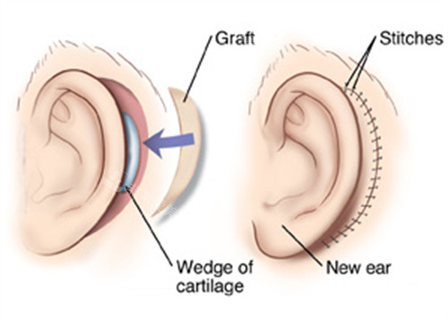 耳再造手術(shù)的切口