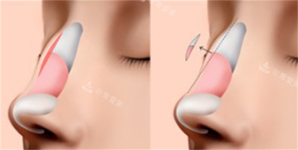 韩国隆鼻前后图片