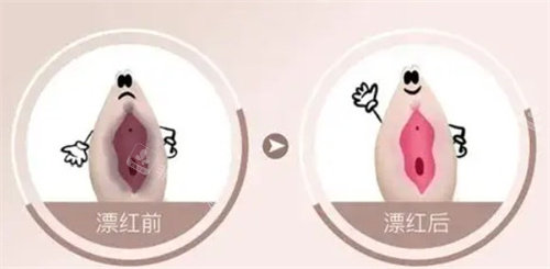 下体外唇部发黑怎么改善？我去韩国妇科专门医做了激光现在粉粉嫩嫩的~