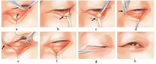去眼袋手術(shù)方法