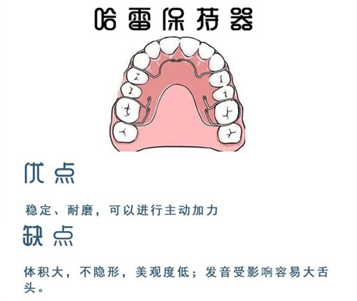 牙齿矫正哈雷保持器