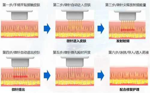 微針操作流程圖解 微針操作流程圖解