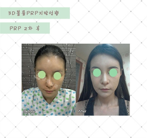 PRP 脂肪移植2 PRP 脂肪移植2