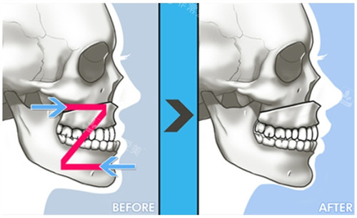 雙鄂手術的過程及對比