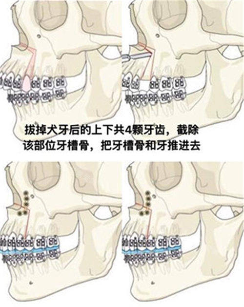 雙鄂手術(shù)方式演示動(dòng)畫圖 雙鄂手術(shù)方式演示動(dòng)畫圖