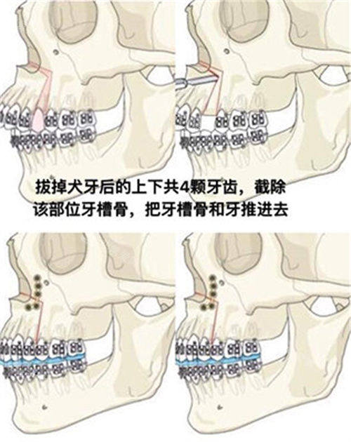 雙鄂手術方式演示動畫圖