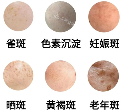 不同的皮膚斑點 不同的皮膚斑點