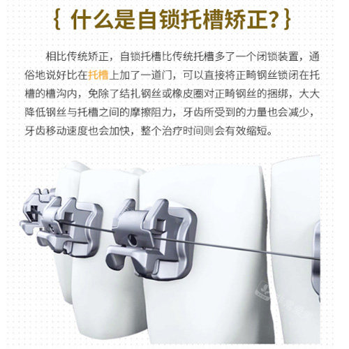 金属自锁托槽矫正原理