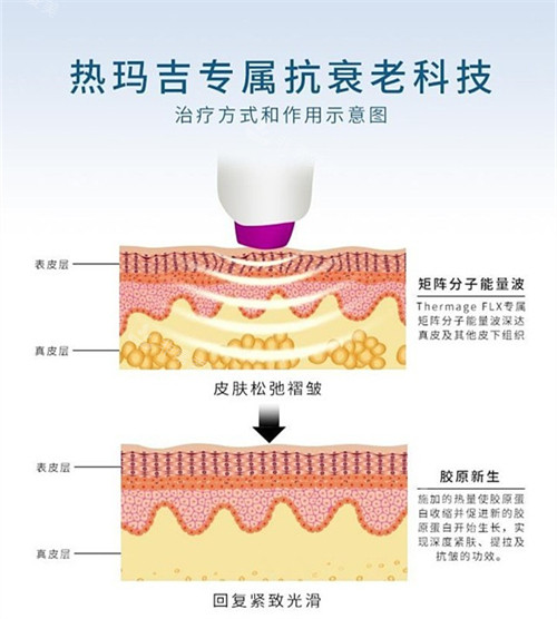 面部除皺熱瑪吉方式演示圖