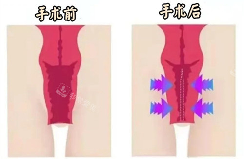 生物束带紧缩术手术前后对比