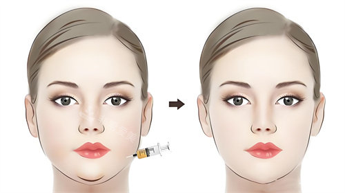 面部注射溶脂針前后對比動畫圖