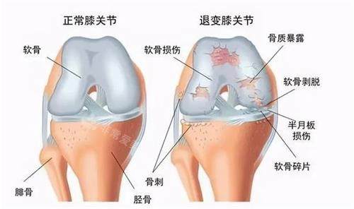 正常膝關(guān)節(jié)和膝蓋關(guān)節(jié)炎的膝蓋對(duì)比