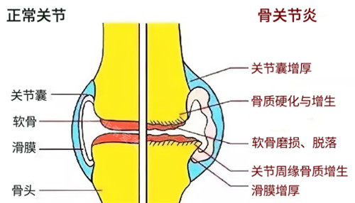 關(guān)節(jié)的炎癥和正常情況表現(xiàn).jpg