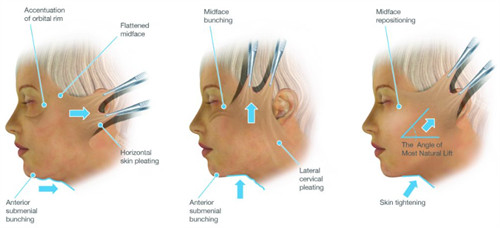 拉皮手術(shù)不同角度