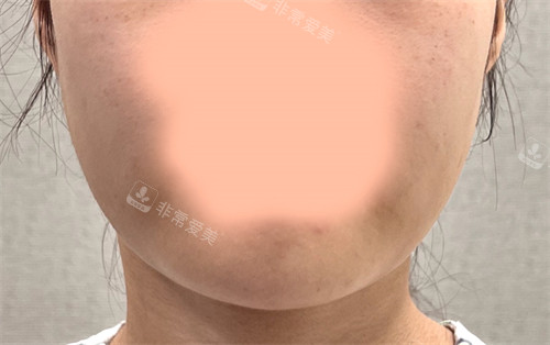 韓國21整形外科醫(yī)院雙下巴肌肉捆綁術(shù)術(shù)前圖 韓國21整形外科醫(yī)院雙下巴肌肉捆綁術(shù)術(shù)前圖