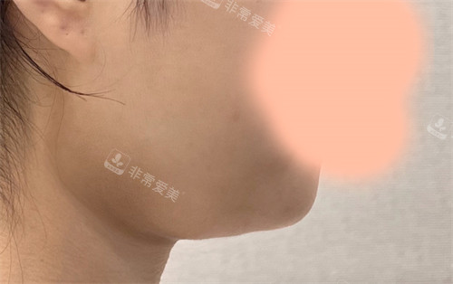 韓國21整形外科醫(yī)院雙下巴肌肉捆綁術(shù)術(shù)前照片 韓國21整形外科醫(yī)院雙下巴肌肉捆綁術(shù)術(shù)前照片