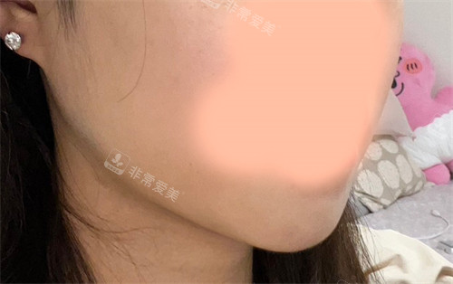 韓國21整形外科醫(yī)院雙下巴肌肉捆綁術(shù)術(shù)后 韓國21整形外科醫(yī)院雙下巴肌肉捆綁術(shù)術(shù)后