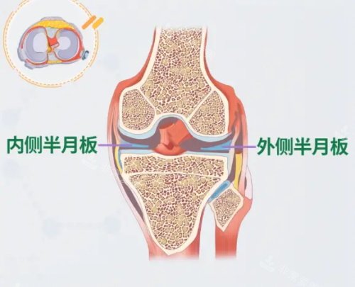 半月板动漫示意图