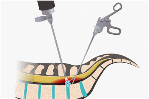 脊椎微創(chuàng)手術(shù)