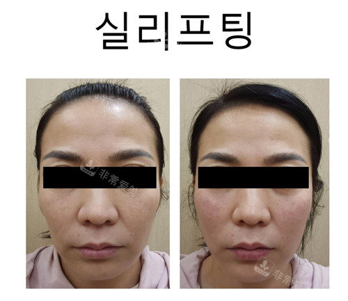 獎(jiǎng)杯皮膚科的一組填充前后對(duì)比 獎(jiǎng)杯皮膚科的一組填充前后對(duì)比