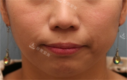 獎(jiǎng)杯皮膚科面部提升+玻尿酸填充前 獎(jiǎng)杯皮膚科面部提升+玻尿酸填充前