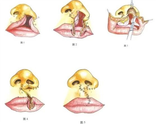 兔唇修復(fù)手術(shù)過(guò)程圖解