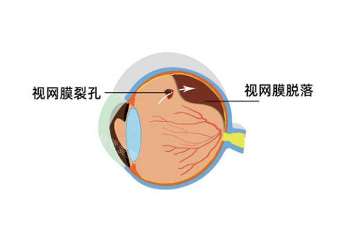 视网膜脱落卡通图片展示