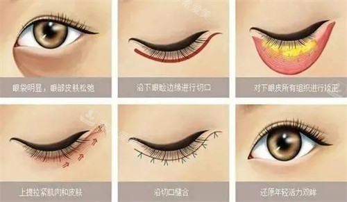 外切去眼袋