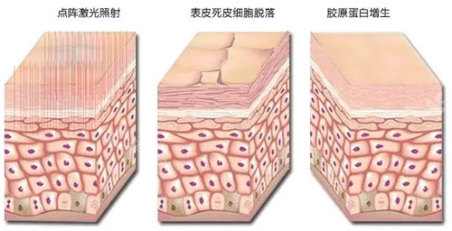 点阵激光过程