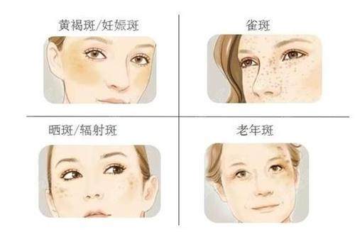 雀斑的種類 雀斑的種類