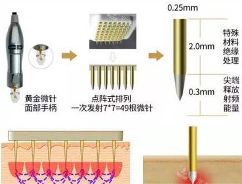 膨脹紋微針治療過程