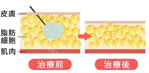 注射溶脂原理卡通圖展示