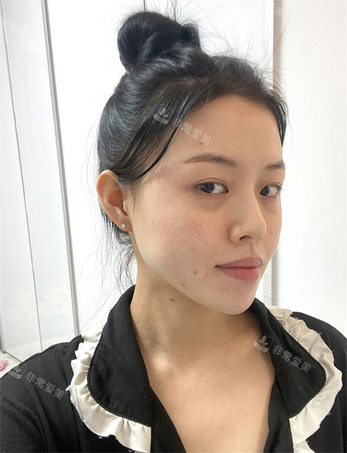 韓國(guó)21整形隆鼻前圖片