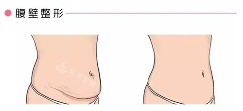 韩国做妈妈臀吸脂+腰腹吸脂的真实经历，你们有需要我觉得可以去！