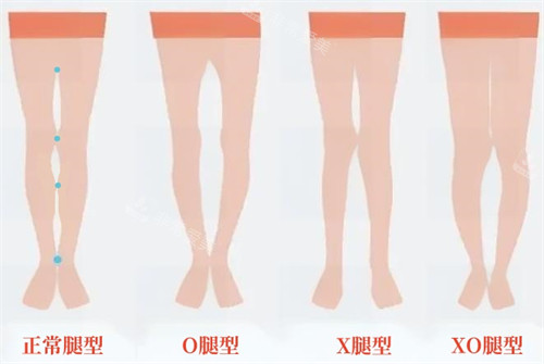 韩国做直腿术哪家医院好?韩国圣路加医院/Qline女性医院/丽迪安整形外科做腿部整形有名!