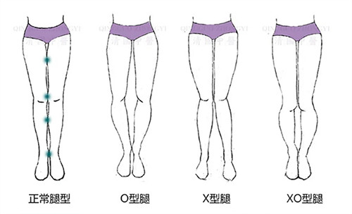 O型腿和X型腿對比圖 O型腿和X型腿對比圖